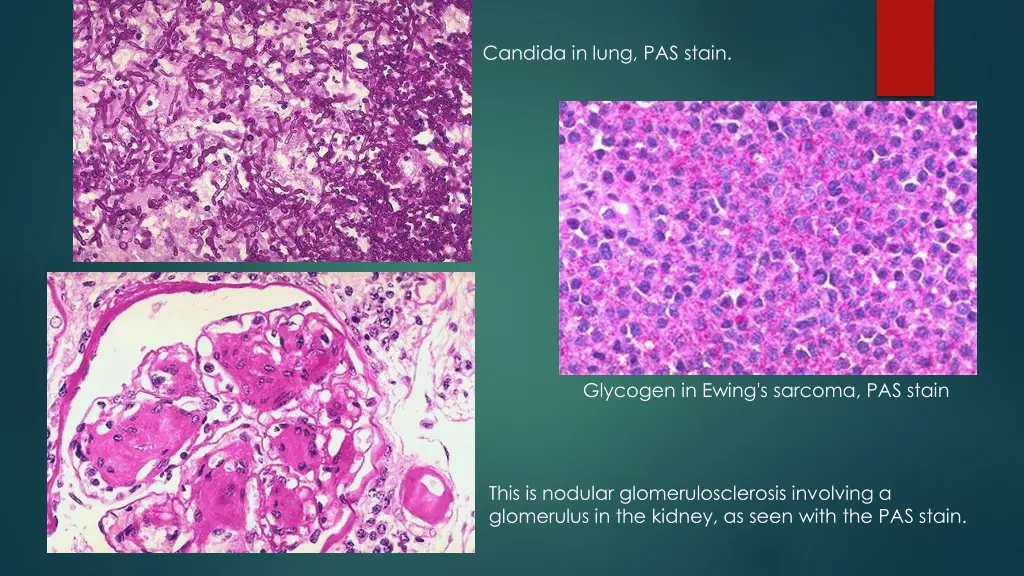 candida in lung pas stain