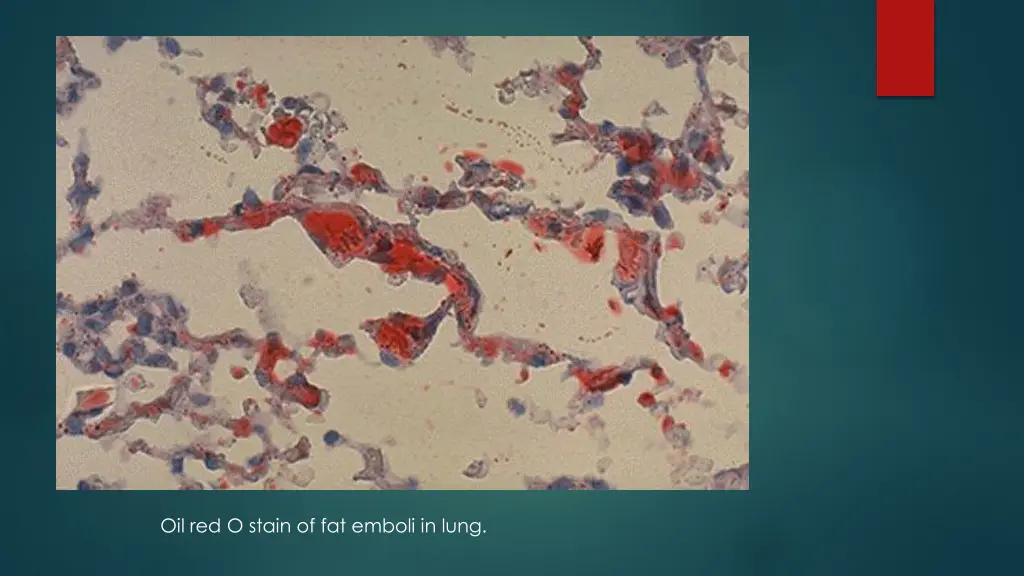 oil red o stain of fat emboli in lung