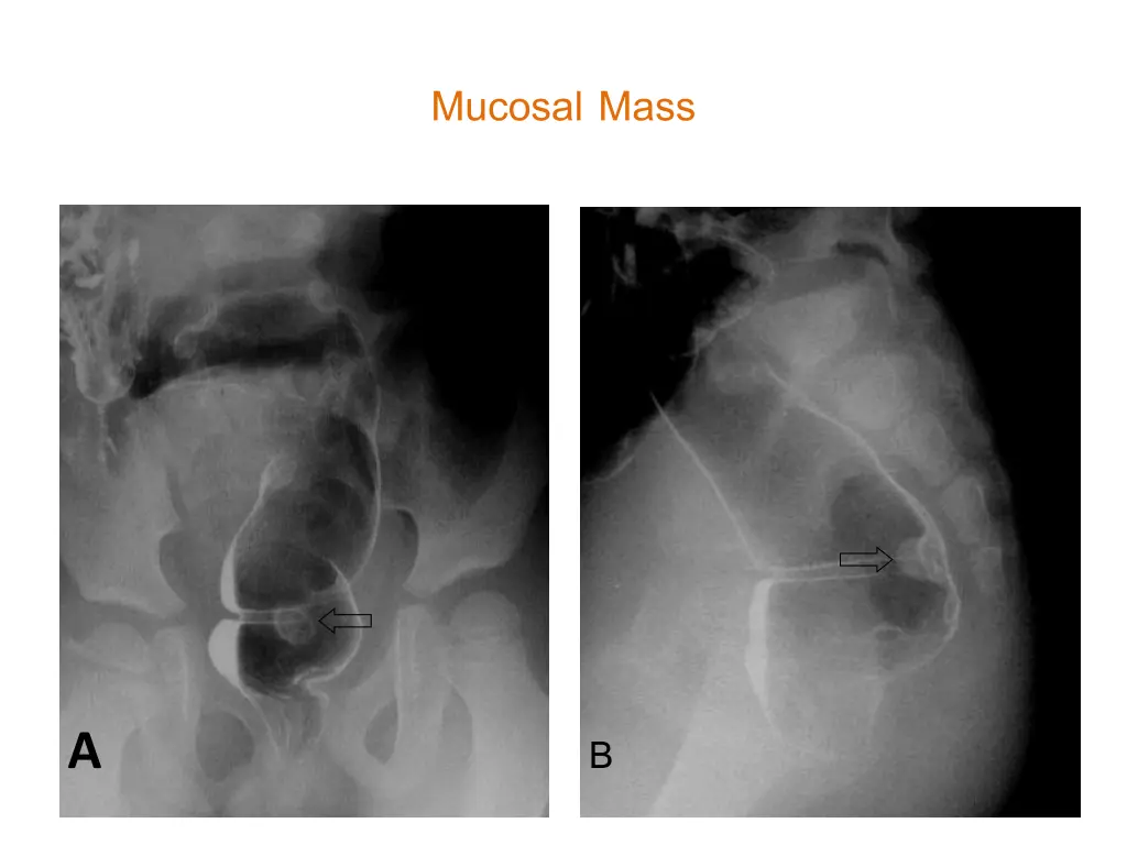 mucosal mass