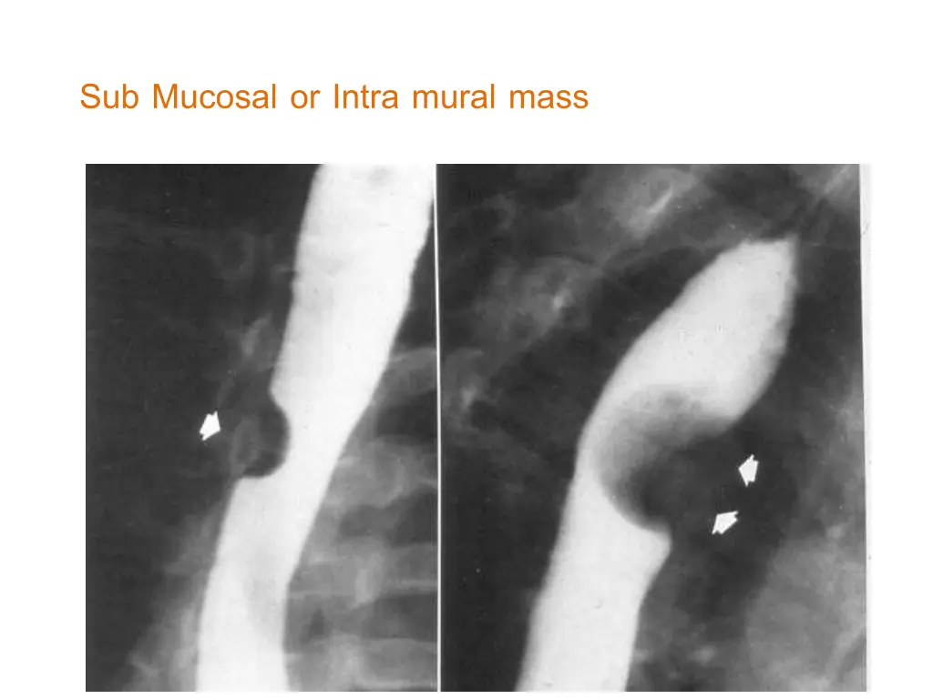 sub mucosal or intra mural mass