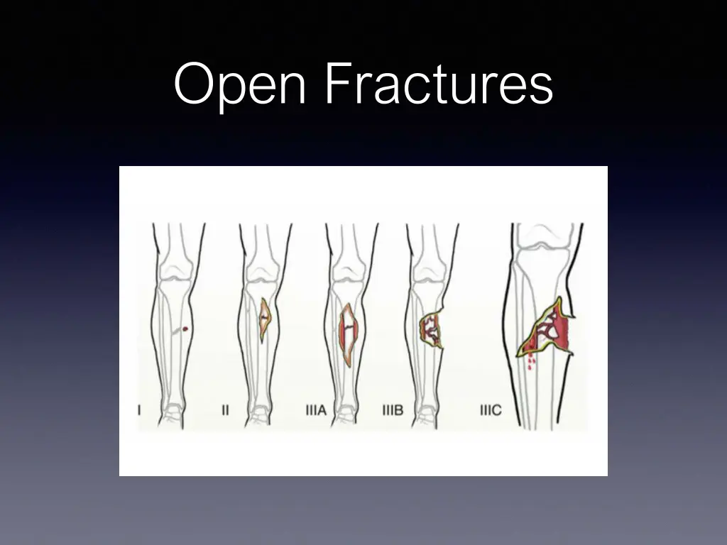 open fractures