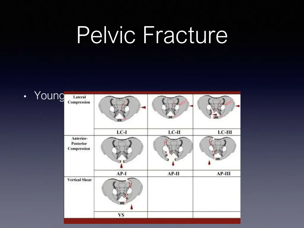 pelvic fracture