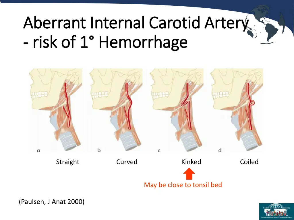 aberrant internal carotid artery aberrant