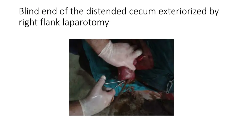 blind end of the distended cecum exteriorized