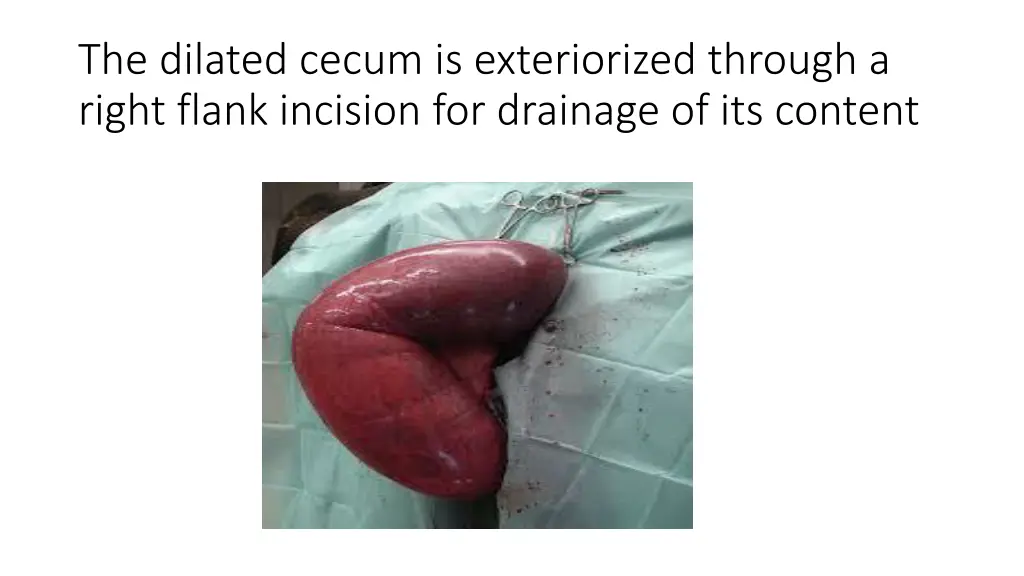 the dilated cecum is exteriorized through a right