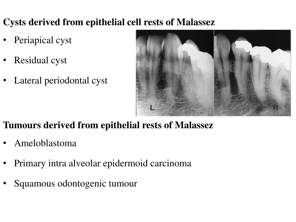 cysts derived from epithelial cell rests