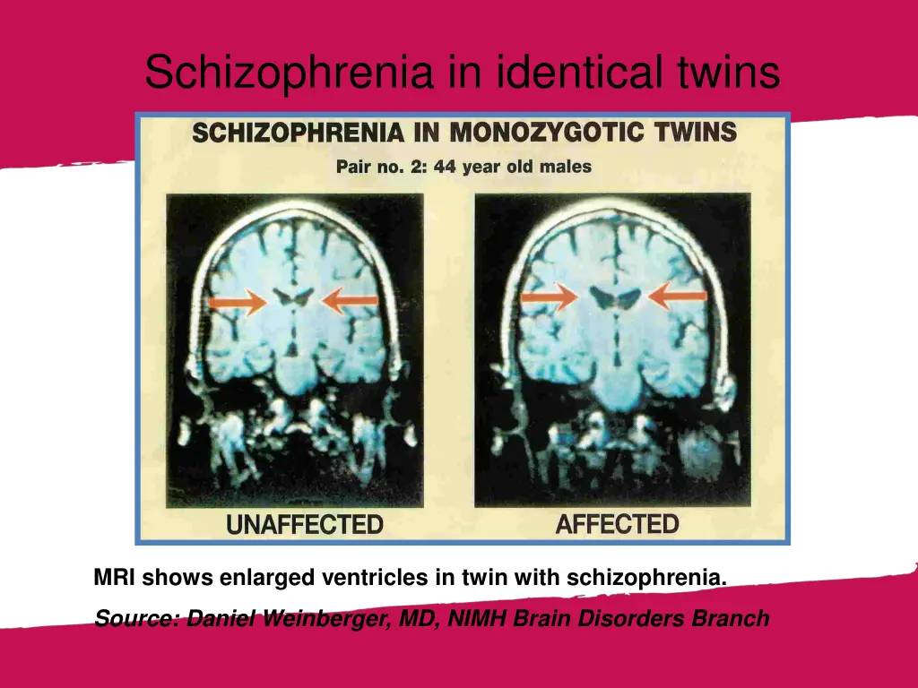 schizophrenia in identical twins