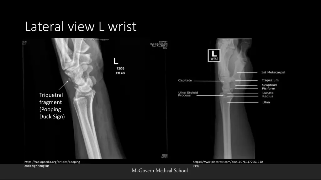 lateral view l wrist