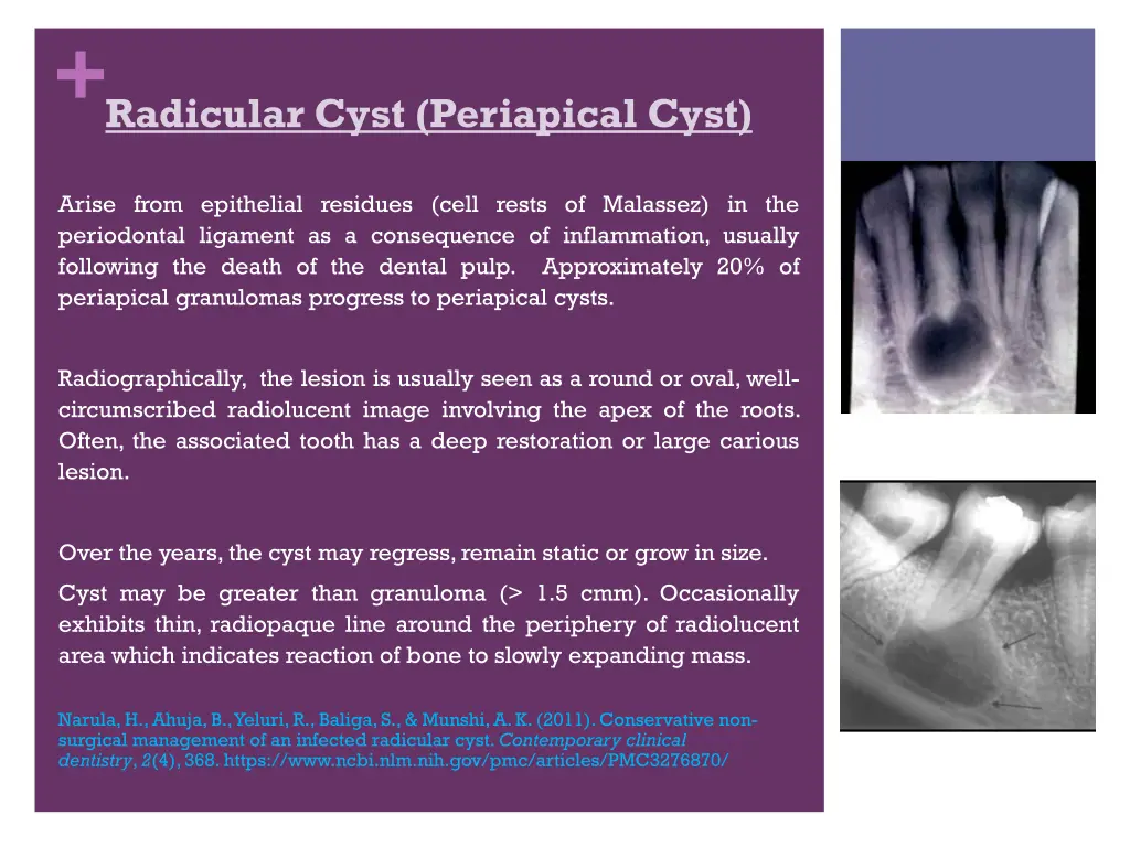 radicular cyst periapical cyst