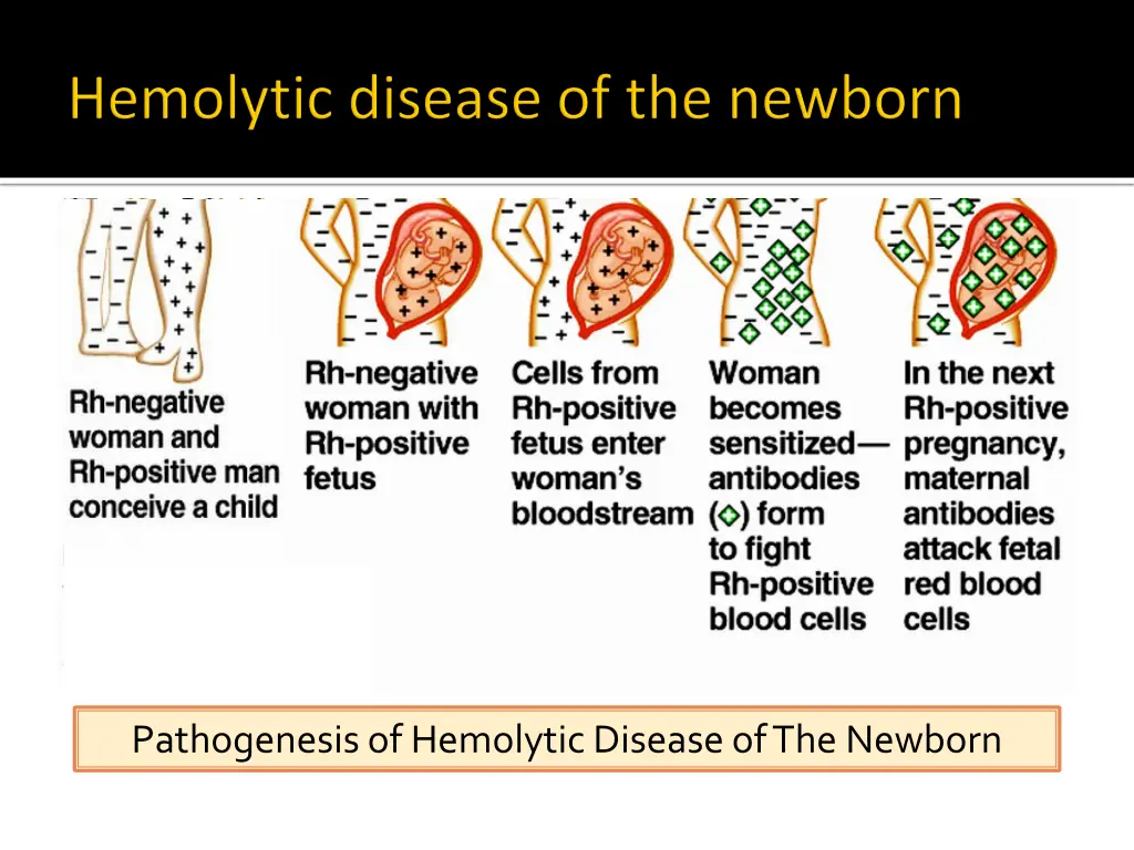 pathogenesis of hemolytic disease of the newborn