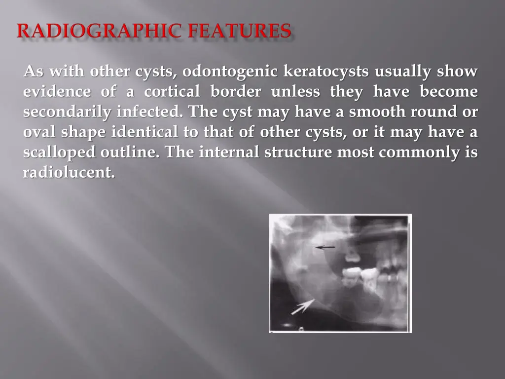 as with other cysts odontogenic keratocysts