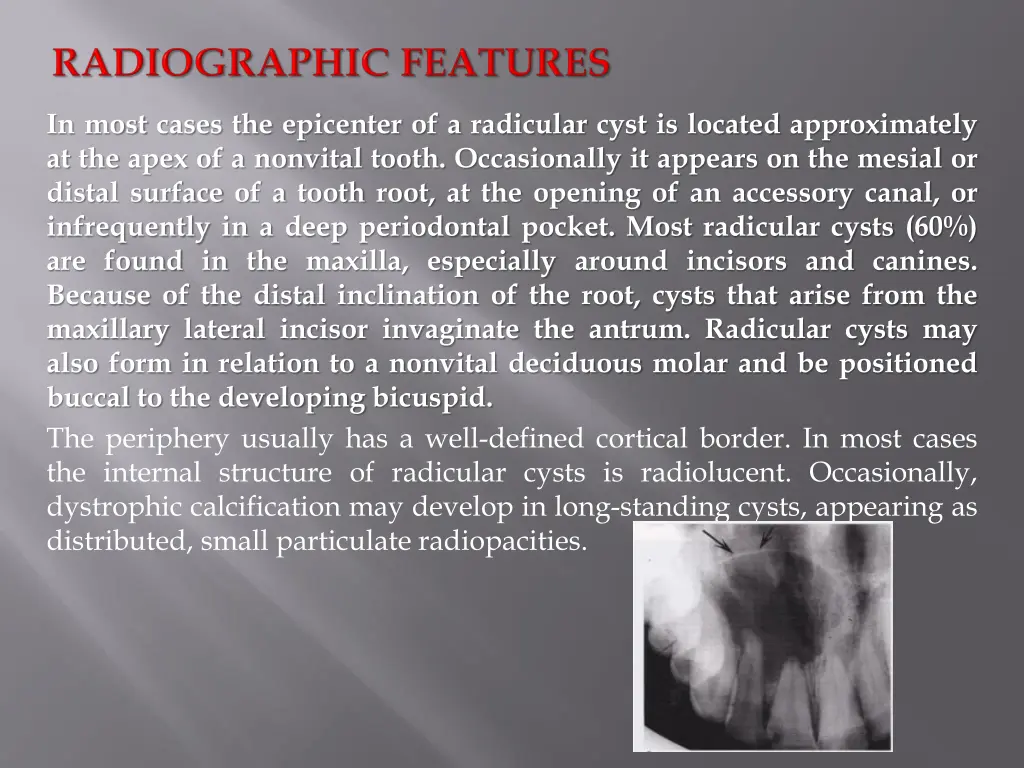 in most cases the epicenter of a radicular cyst