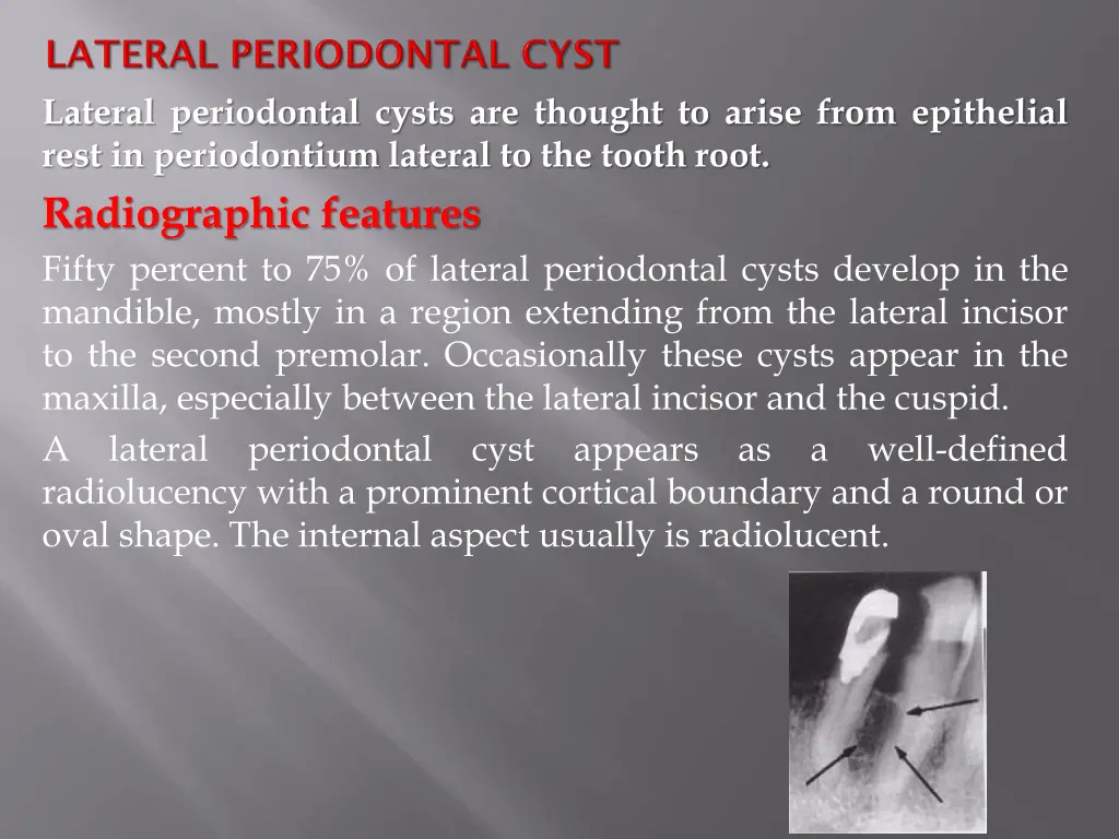 lateral periodontal cysts are thought to arise