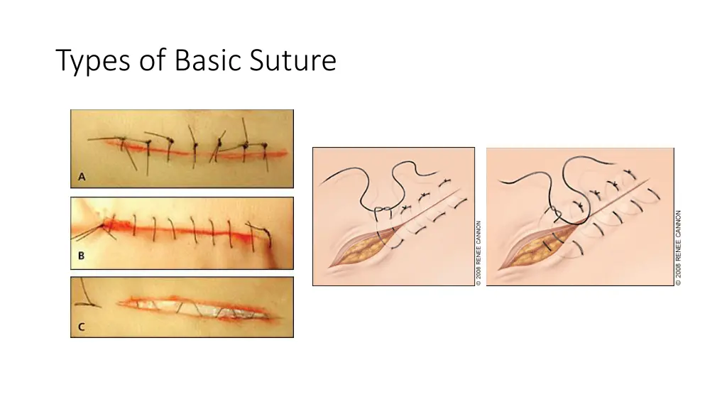 types of basic suture