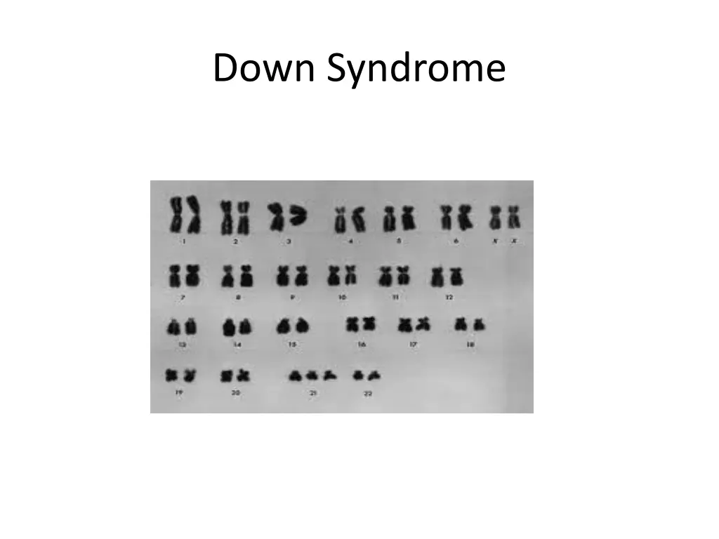 down syndrome