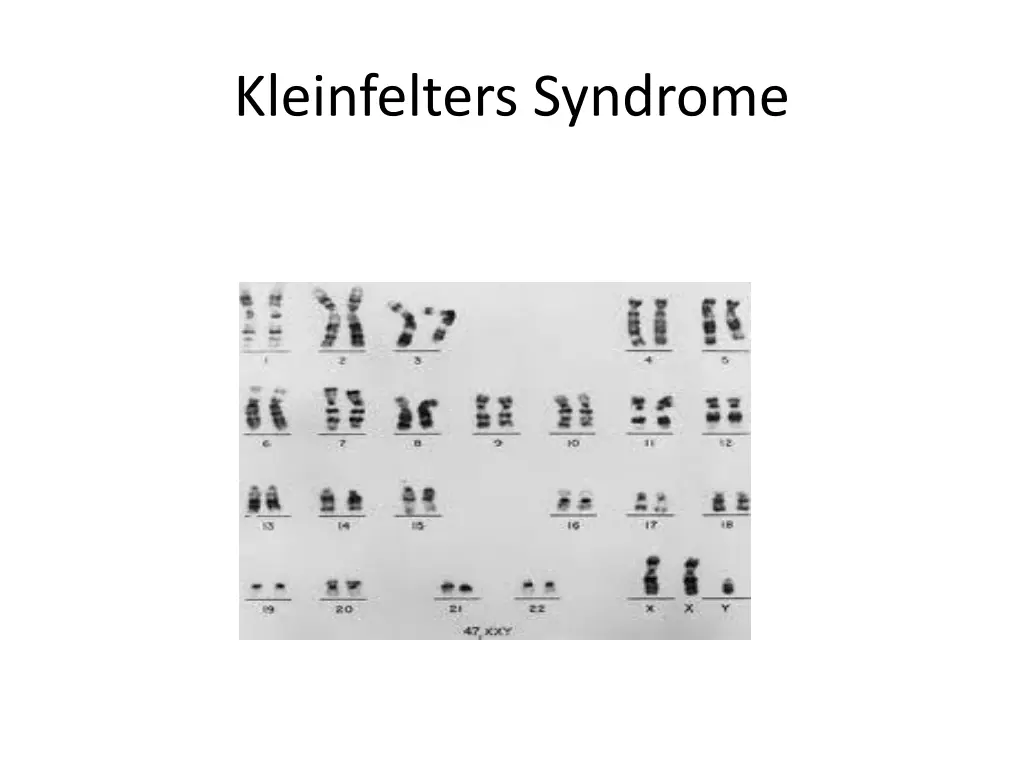 kleinfelters syndrome