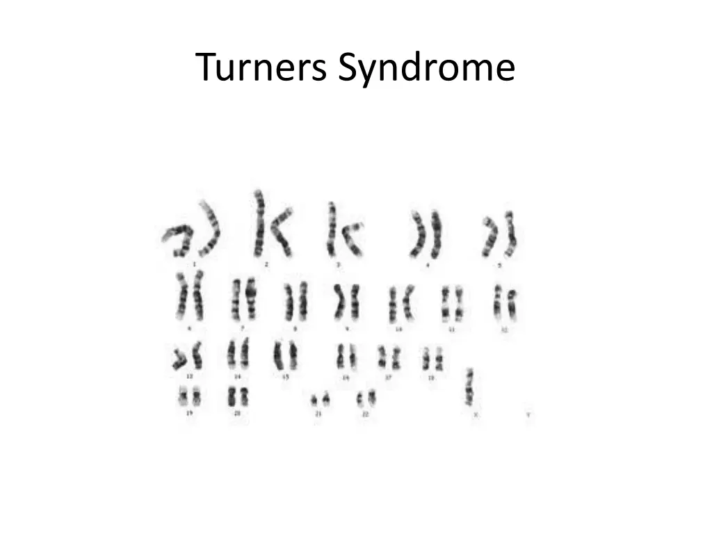 turners syndrome