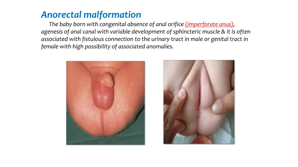 anorectal malformation the baby born with