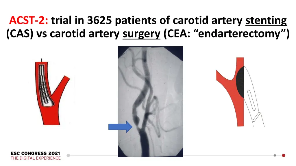 acst 2 trial in 3625 patients of carotid artery