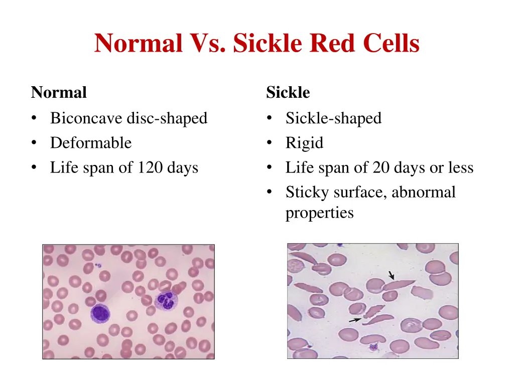 normal vs sickle red cells