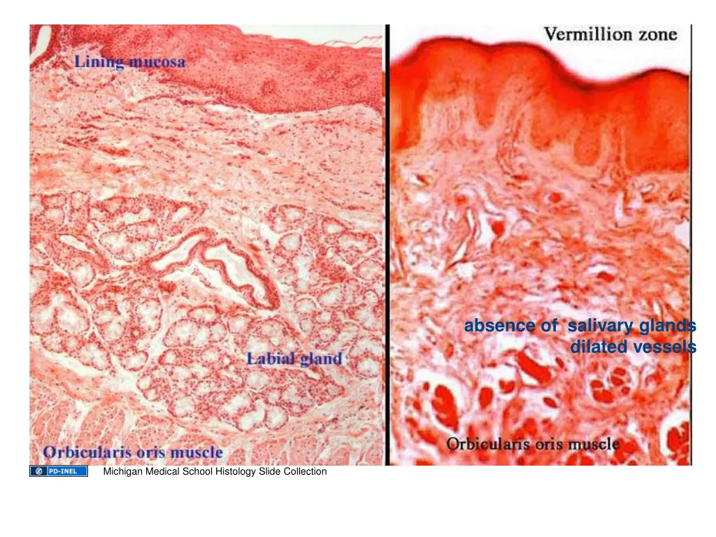 absence of salivary glands dilated vessels