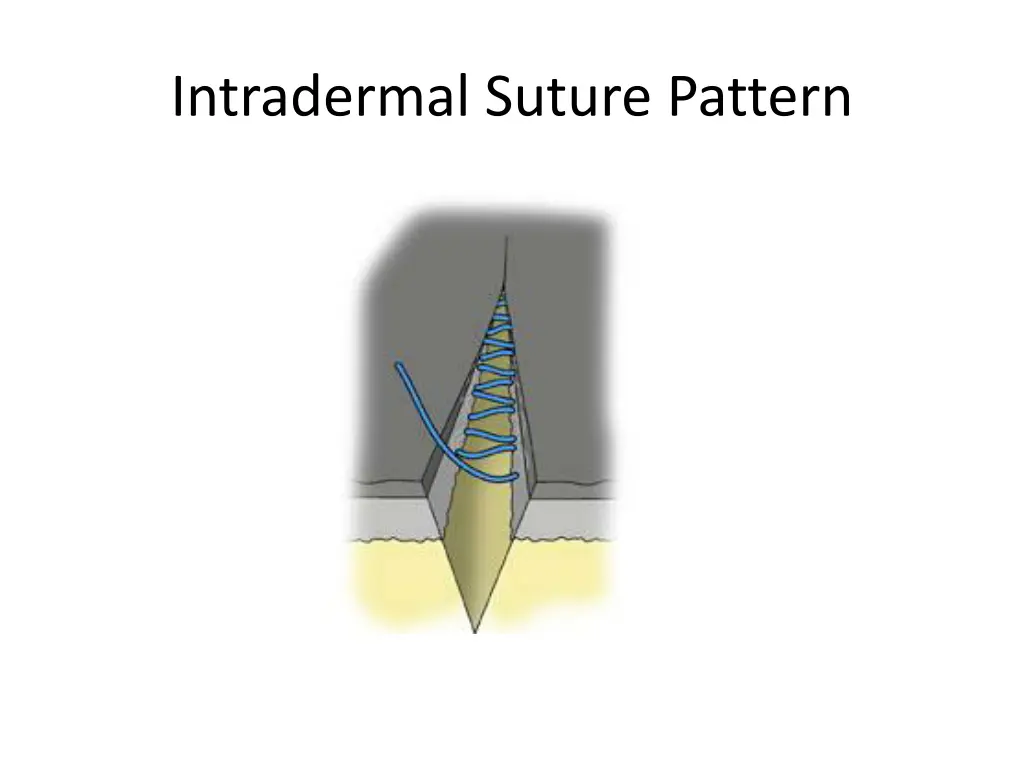 intradermal suture pattern 1