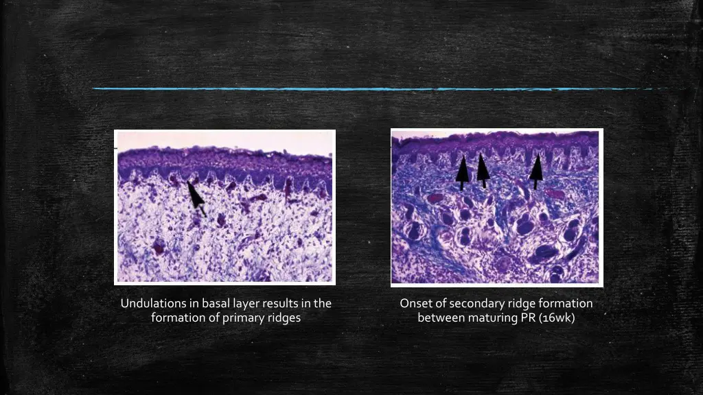 undulations in basal layer results