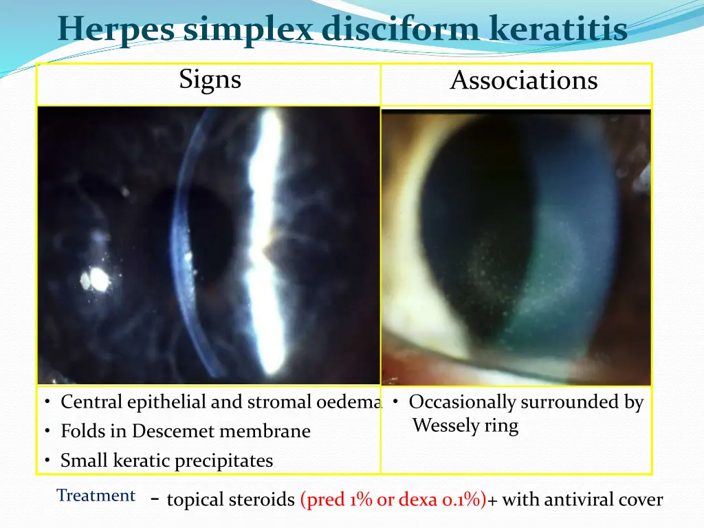 herpes simplex disciform keratitis