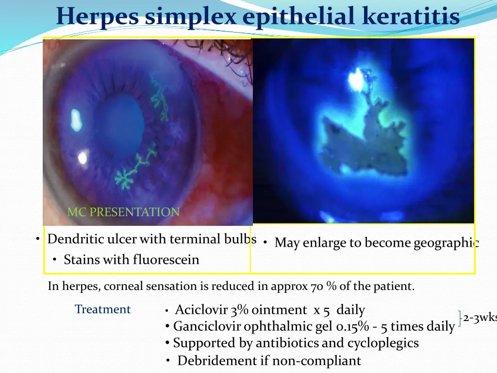 herpes simplex epithelial keratitis