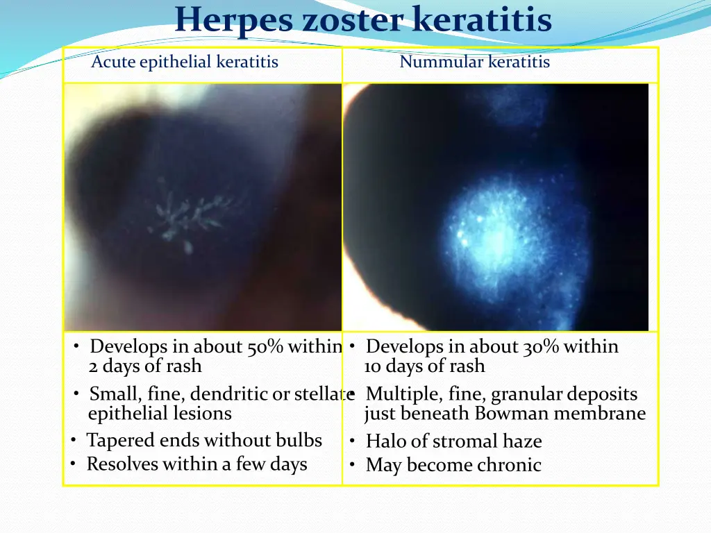 herpes zoster keratitis