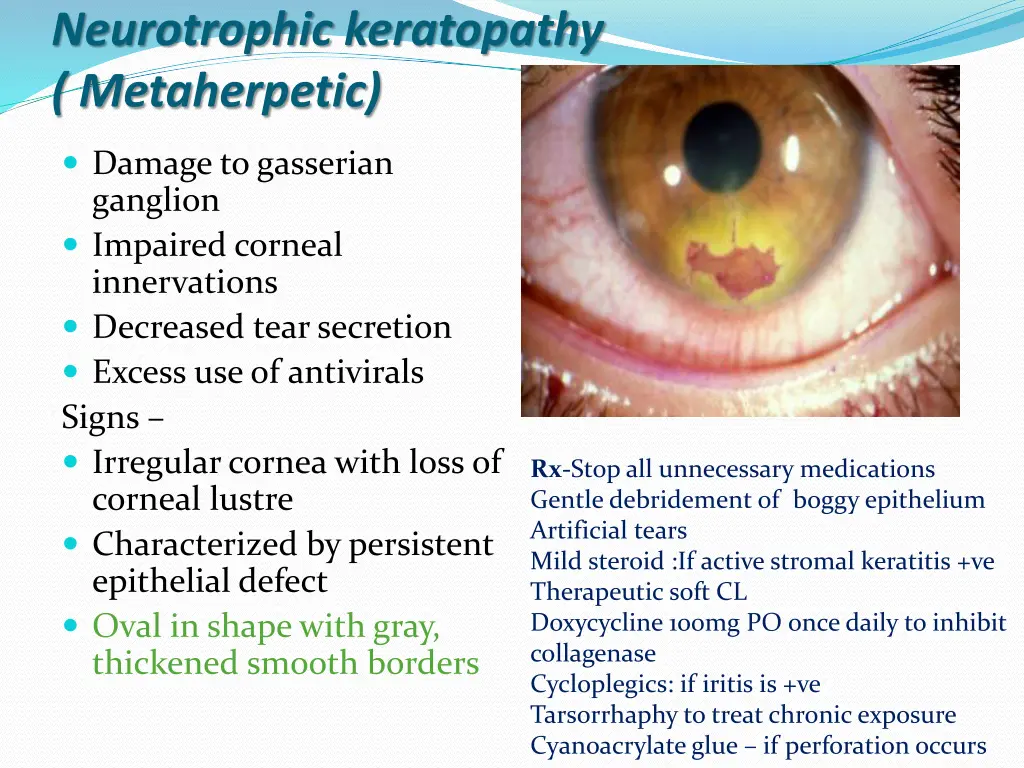 neurotrophic keratopathy metaherpetic