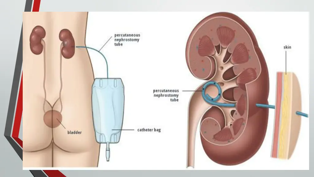 nephrostomy