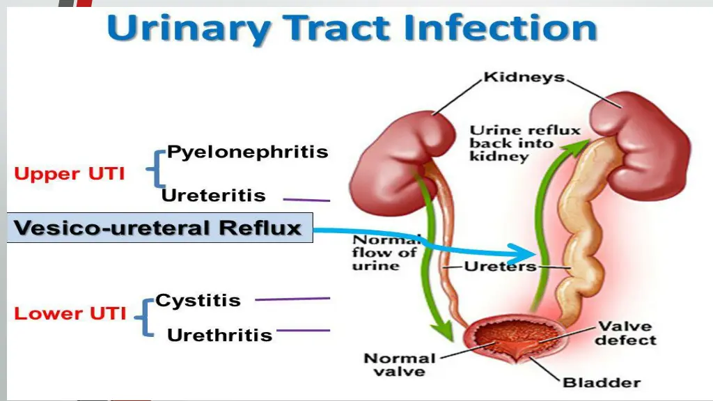 urinary tract infection