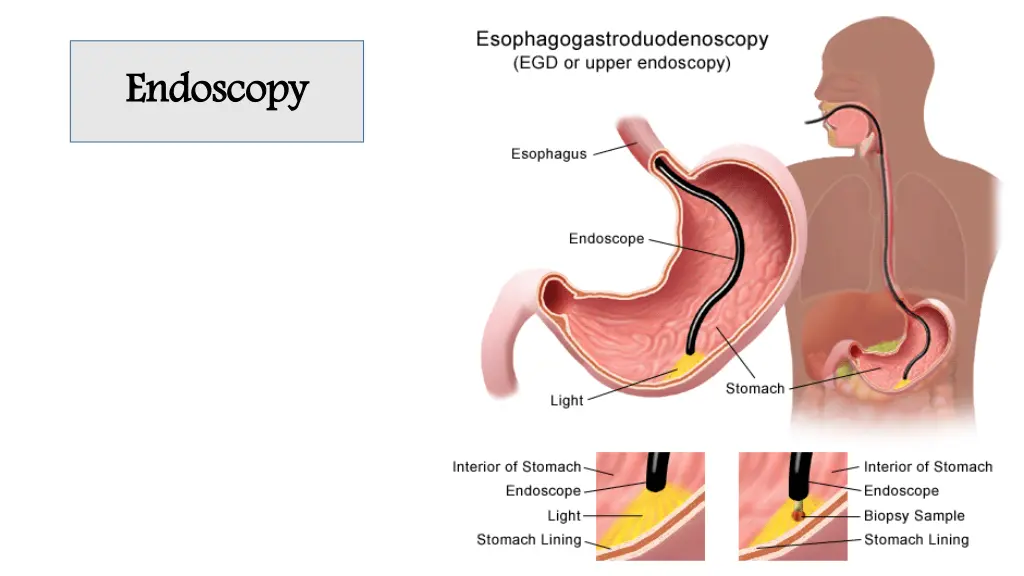 endoscopy