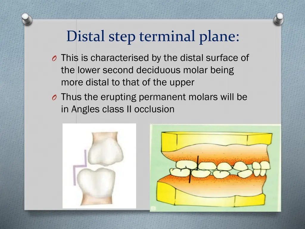 distal step terminal plane