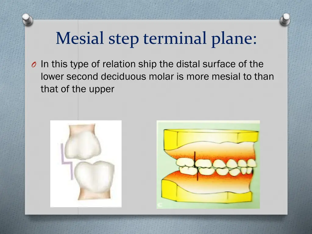 mesial step terminal plane