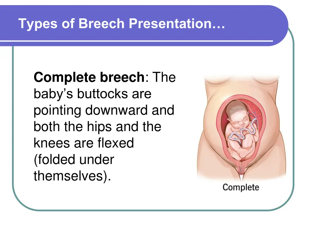 types of breech presentation 1