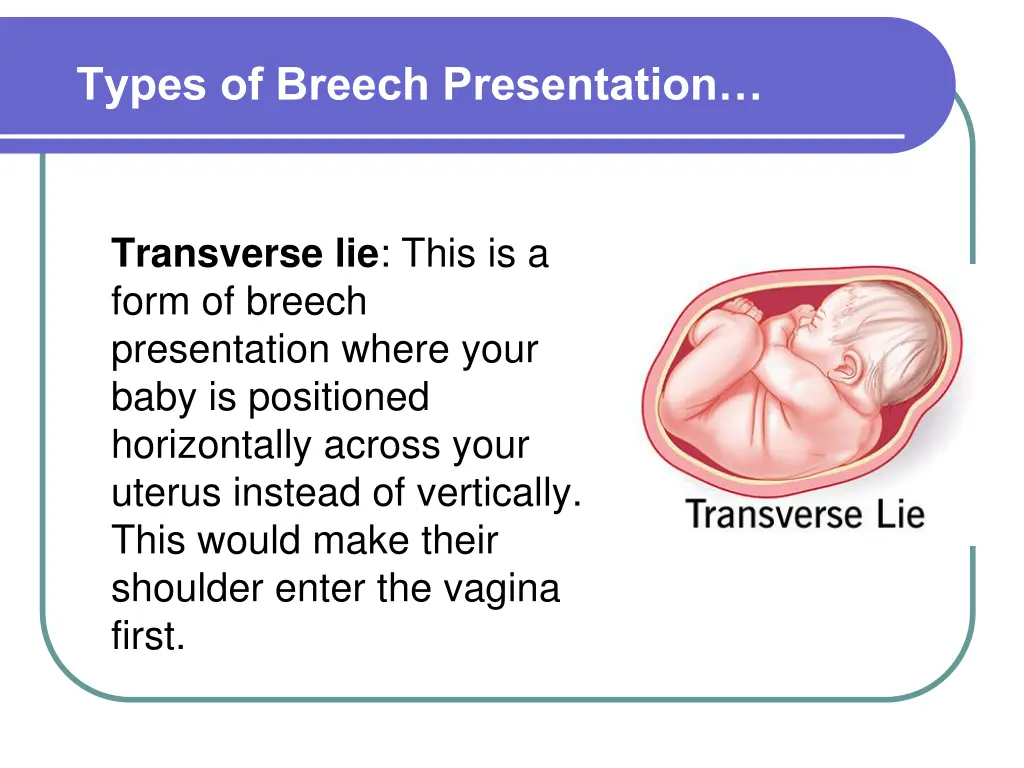 types of breech presentation 3