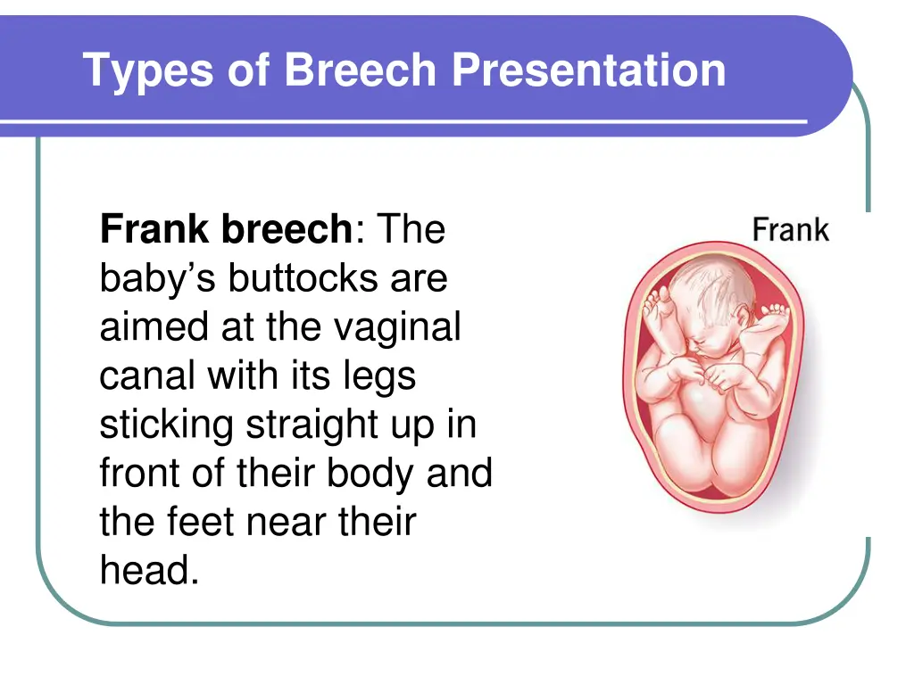 types of breech presentation