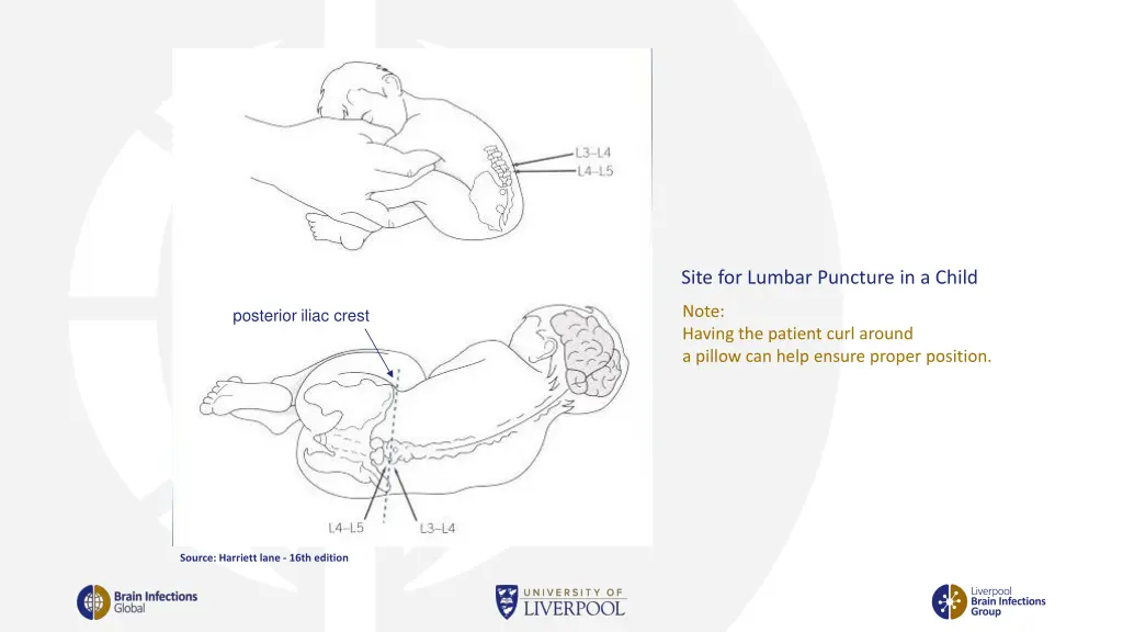 site for lumbar puncture in a child