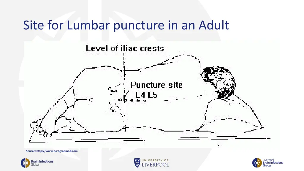 site for lumbar puncture in an adult