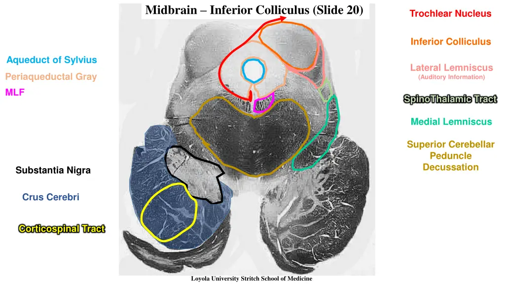 midbrain inferior colliculus slide 20