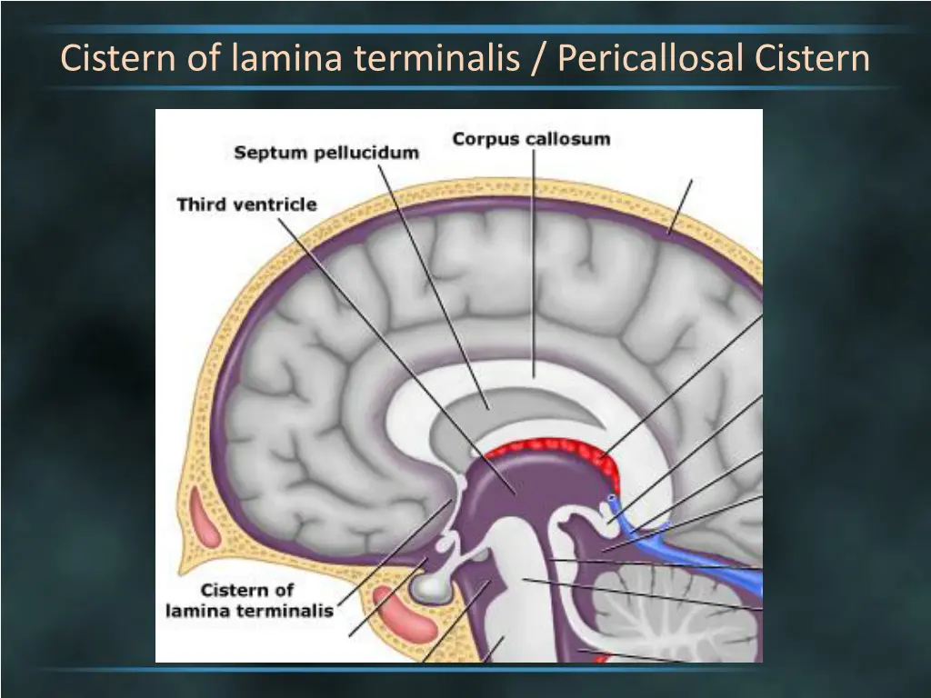 cistern of lamina terminalis pericallosal cistern 1