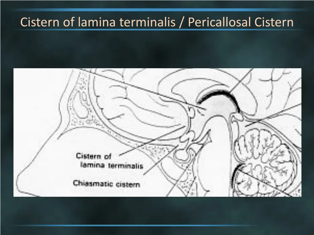 cistern of lamina terminalis pericallosal cistern 2