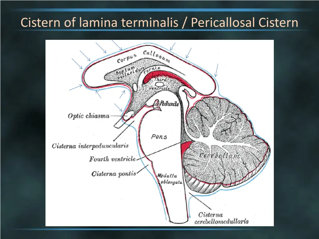 cistern of lamina terminalis pericallosal cistern 3