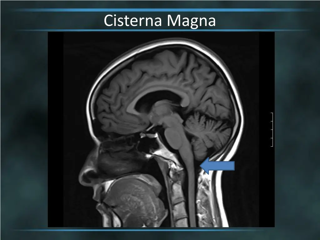 cisterna magna 2