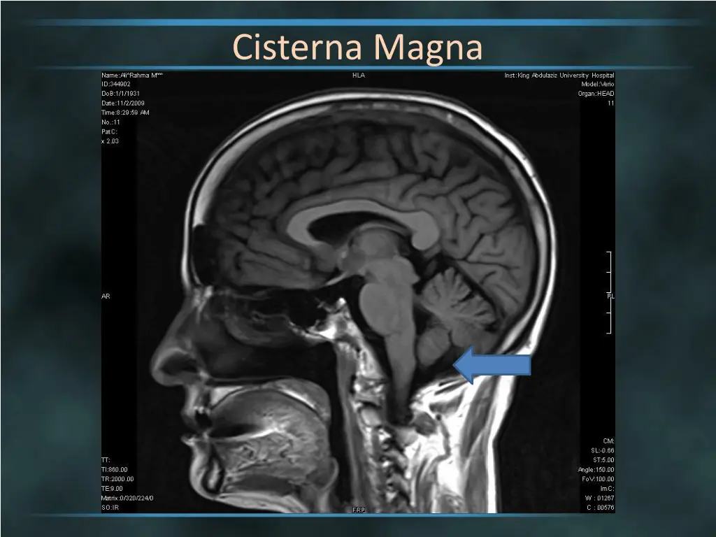 cisterna magna 3