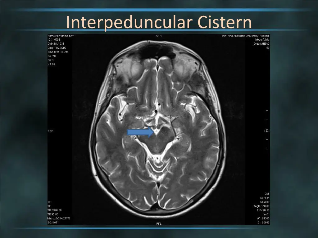 interpeduncular cistern 3