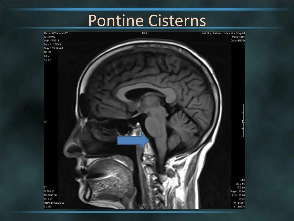 pontine cisterns