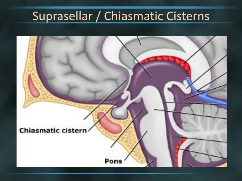 suprasellar chiasmatic cisterns 1